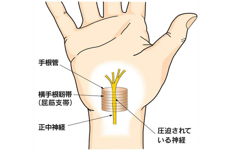 手根管症候群