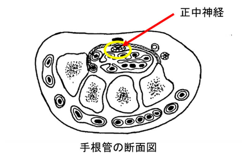 手根管症候群