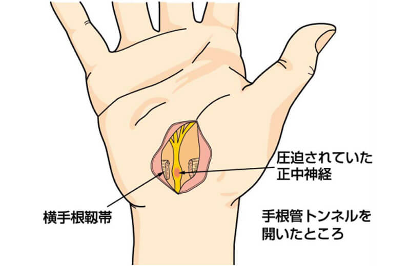 手根管症候群