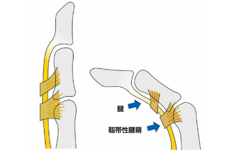 指、手関節の腱鞘炎（ばね指）