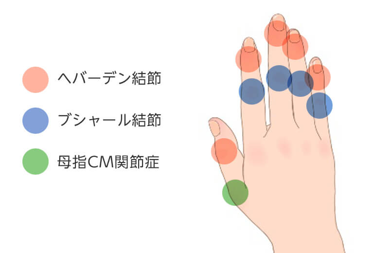 指の変形性関節症