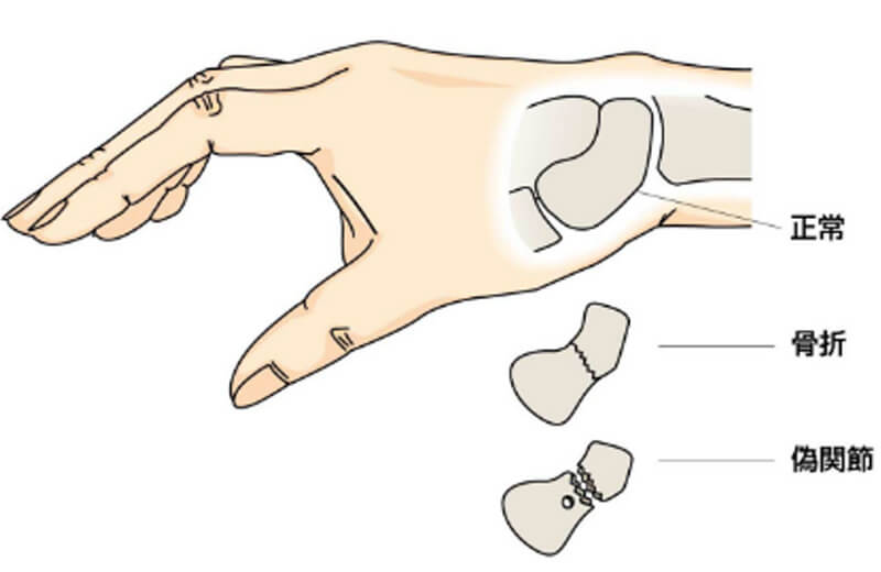 指、手関節の骨折（舟状骨骨折）、靱帯損傷