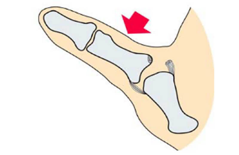 指、手関節の骨折（舟状骨骨折）、靱帯損傷