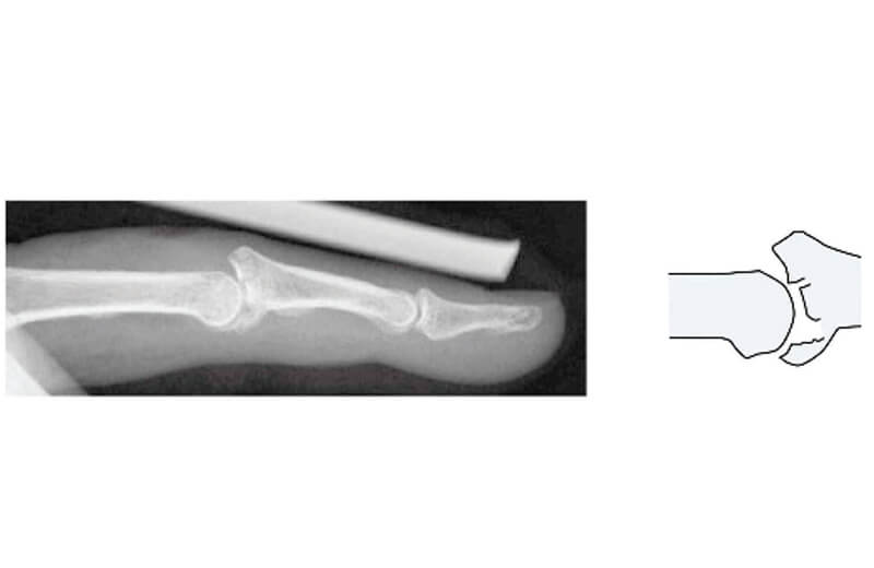 指、手関節の骨折（舟状骨骨折）、靱帯損傷