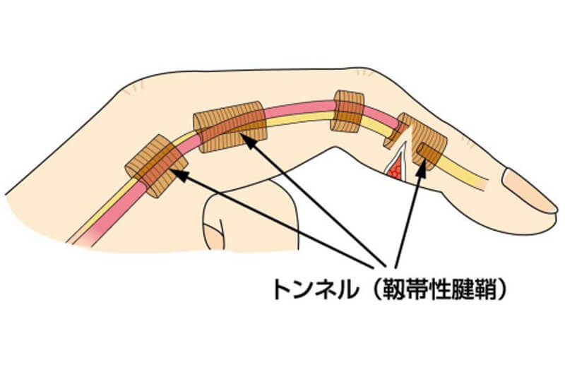 腱の損傷