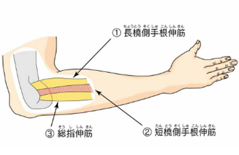 テニス肘